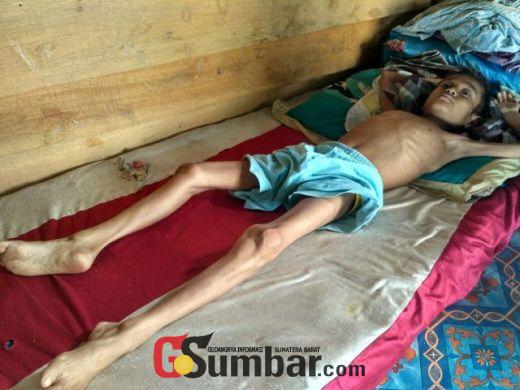 Nestapa Pelajar SMP di Dharmasraya, Terbaring Lemah di Rumah, Badannya Begitu Kurus Ortu Tak Punya Uang